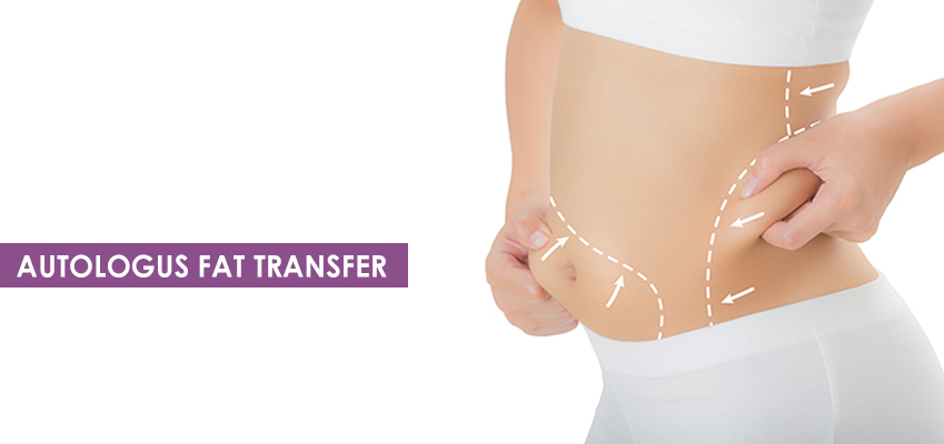 Autologous Fat Transfer